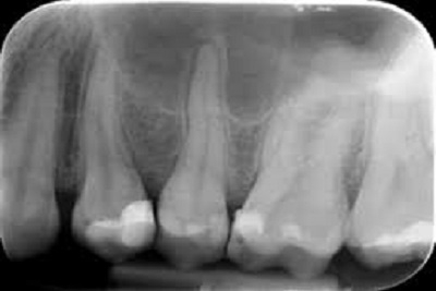 Retroalveolarni snimak zuba ( pojedinačno snimanje zuba)  | Akcija